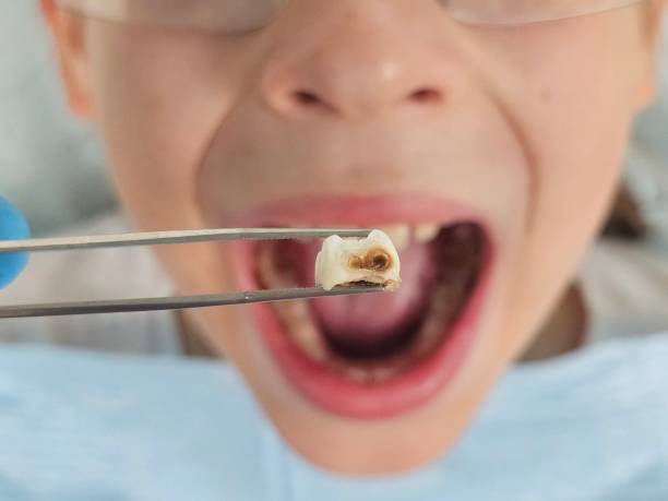 Best Urgent Care for Lost Fillings or Crowns in Upper Lake, CA
